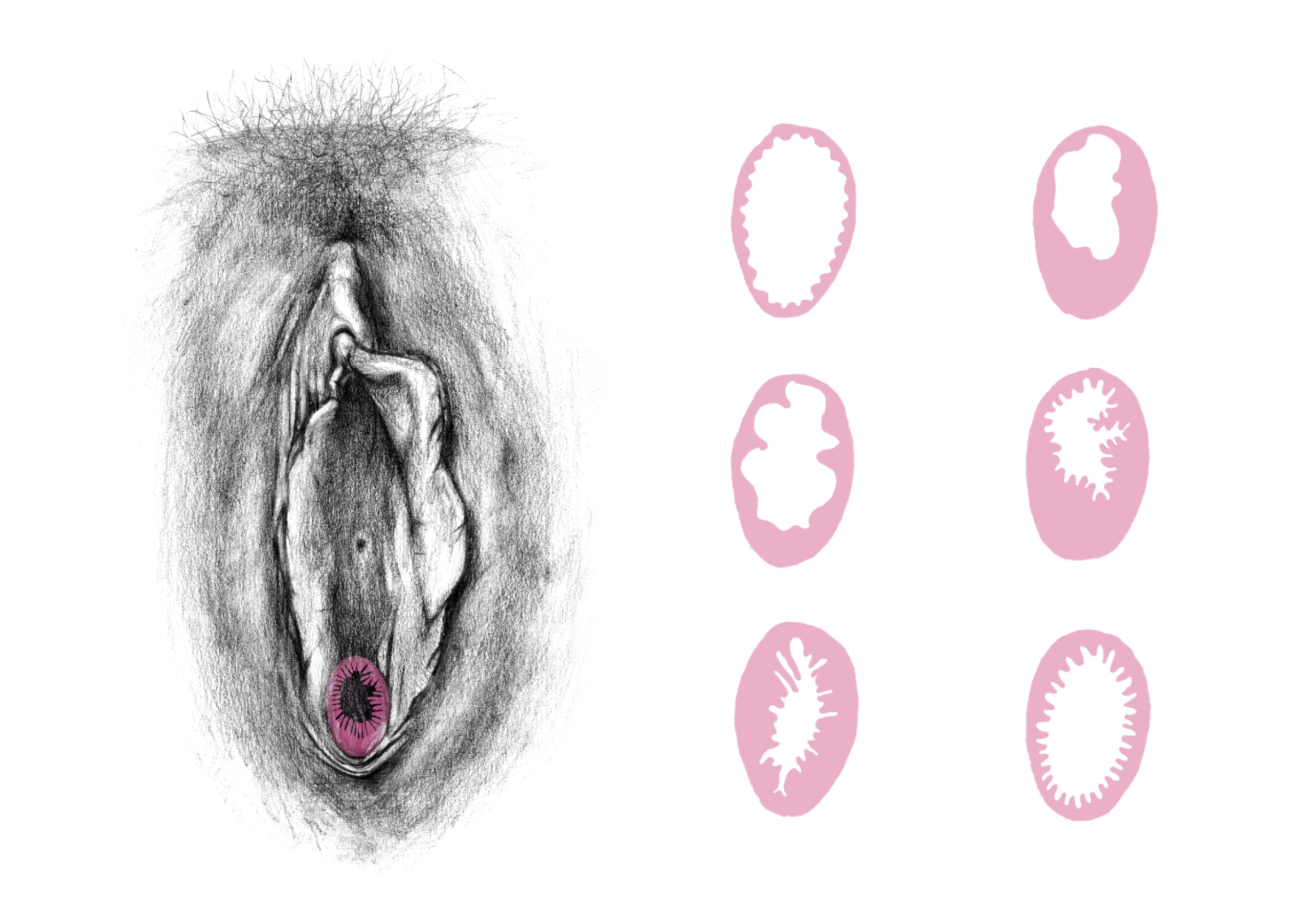 Illustration av en vulva med små ritningar av hur slidkransen kan se ut.